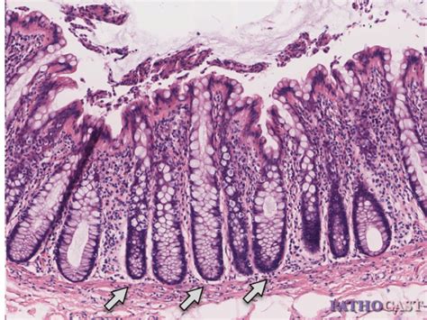 Colonic Mucosa Without Pathologic Findings Doccheck