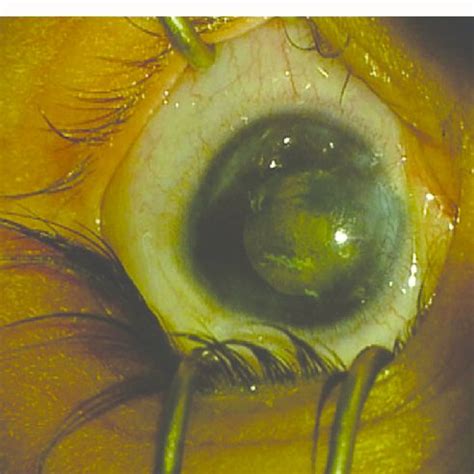 Image Of The Anterior Segment Of The Patient S Left Eye Showing Patchy