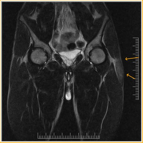 Tensor Fascia Latae Strain Sumers Radiology Blog