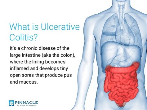 Understanding Ulcerative Colitis