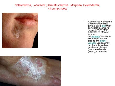 Localized Scleroderma Ppt Download