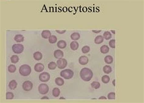 Anisocytosis - Definition, Causes and Treatment