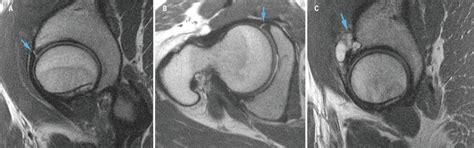 Diagnostic Imaging Of The Hip For Physical Therapists Physiopedia