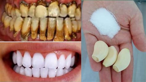 Teeth Whitening At Home In 3 Minutes How To Naturally Whiten Your Yellow Teeth 100