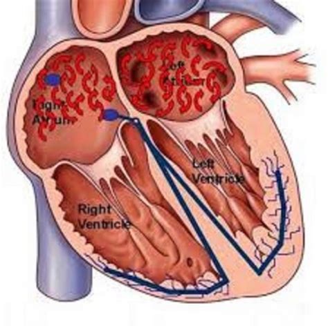 Atrial Fibrillation Symptoms - Gifyu