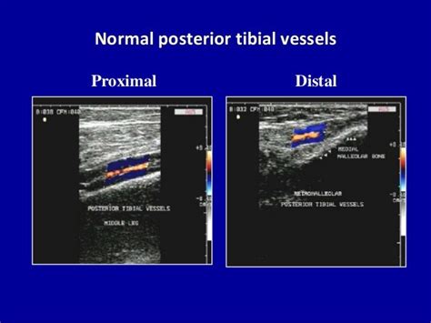 Doppler ultrasound of lower limb arteries