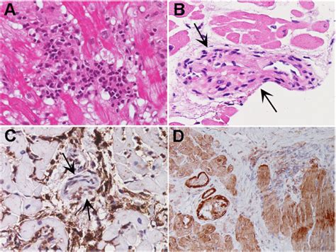 A Left Ventricular Endomyocardial Biopsy Showing Active Lymphocytic