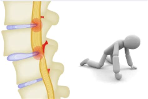 What is Intermittent Claudication? | International Lumbago Clinic