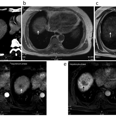 A 57 Year Old Male With A Well Differentiated Hepatocellular Carcinoma