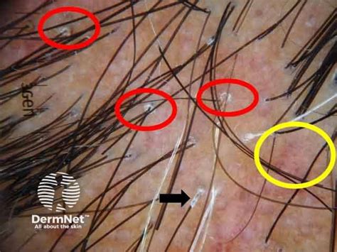 Dermnet® Trichoscopy Of Localised Cicatricial Hair Loss — Dermnet