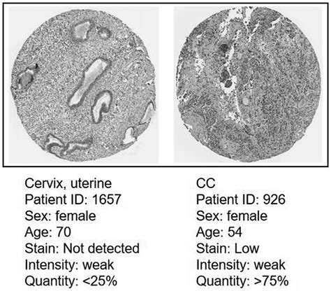 Analysis of the protein expression level of CDC45 in CC by the Human ...