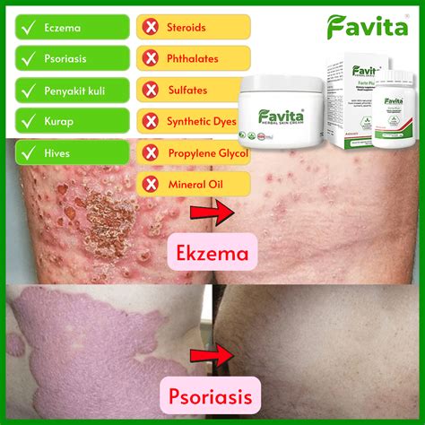 Favita Cream Dan Pill Penyelesaian Terbaik Untuk Kulit Gatal Eczema