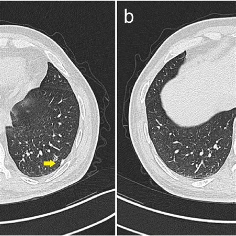 CT Scan Revealed A Solid Nodule In The Outer Basal Segment Of The Left