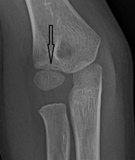 Lateral Epicondyle Fracture