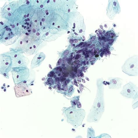 Fig Endocervical Adenocarcinoma In Situ University Of