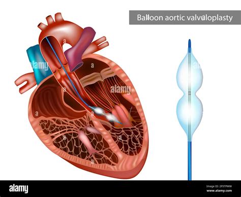 Estenosis Mitral Cirugia Im Genes Vectoriales De Stock Alamy