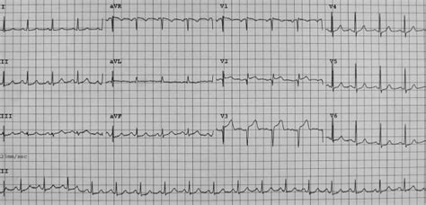 Twelve Lead Electrocardiogram On Admission Sinus Tachycardia With 23