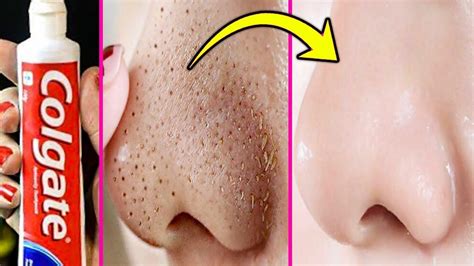 How To Get Rid Of Acne Pimples Tiny Bumps On Face Overnight Simple Home Remedy Diy Treatment