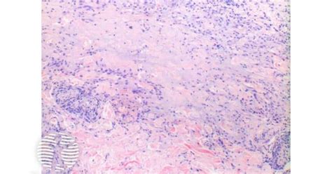 Granuloma Annulare Pathology Image