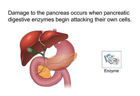 Pancreatitis