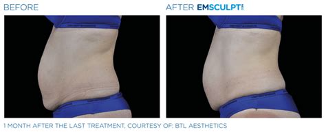 Emsculpt NEO Before And After Pictures Shape Med Centers