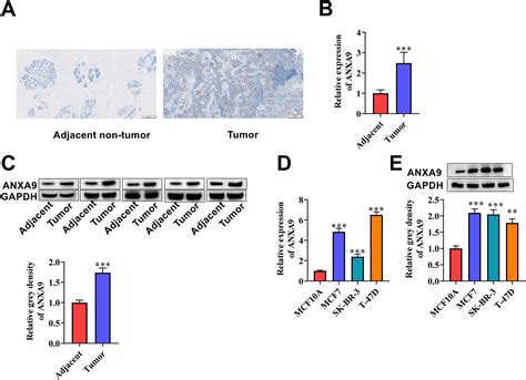 Exosomederived Anxa Functions As An Oncogene In Breast Cancer Lu