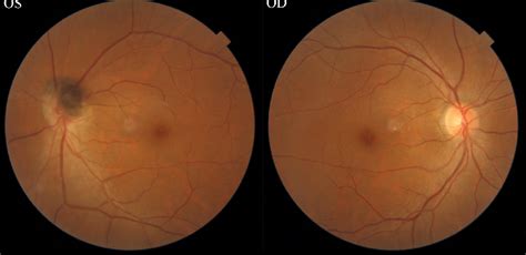 Figure 1 From Optic Disc Melanocytoma A Case Report Semantic Scholar