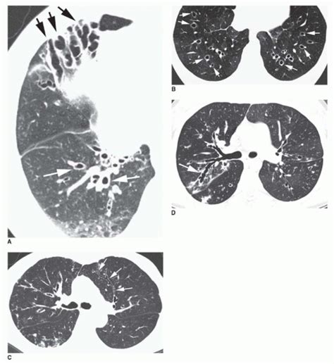 Airway Disease Bronchiectasis Chronic Bronchitis And Bronchiolitis