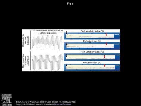 Pleth Variability Index To Monitor The Respiratory Variations In The