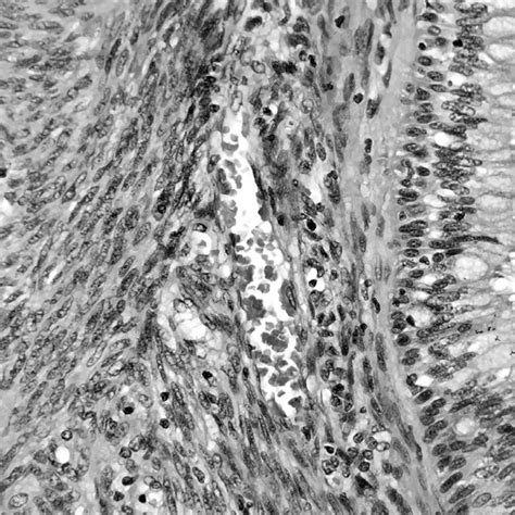 Closely Packed Spindle Cells In Short Fascicles Surrounding A