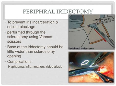 Trabeculectomy