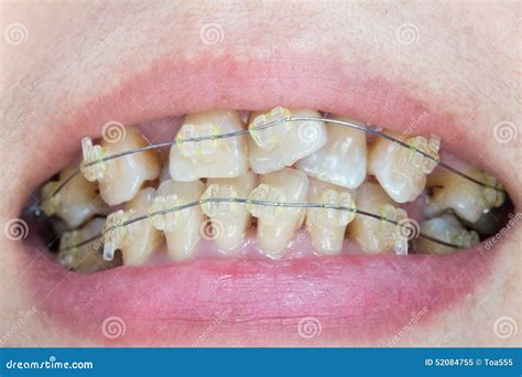 Crooked Teeth With Braces Stock Photo - Image: 52084755