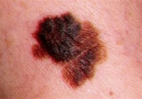 Melanoma Cut Neo Maligno Cecr