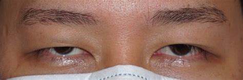 Ptosis All You Need To Know About Drooping Eyelids