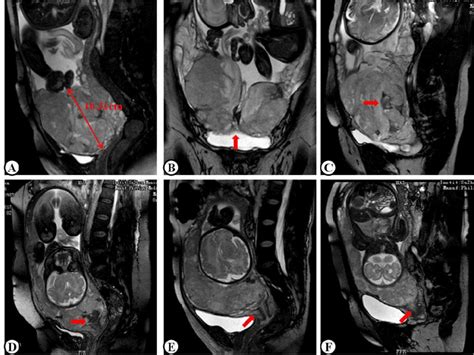 Different Imaging Characteristics Of Mri In Placenta Previa Patients Download Scientific