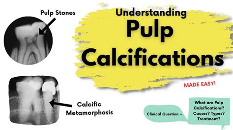 Pulp Calcifications What Is It Types Treatment Endodontics