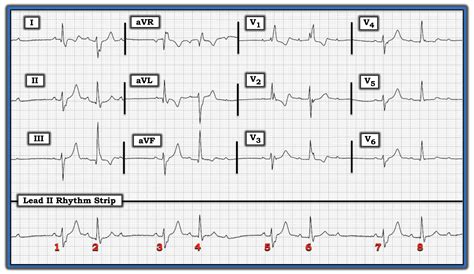 Ecg Interpretation Ecg Blog 206 — How Many Conduction Defects