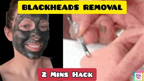 How To Remove Blackheads BlackHead Removal Nose Blackheads Removal