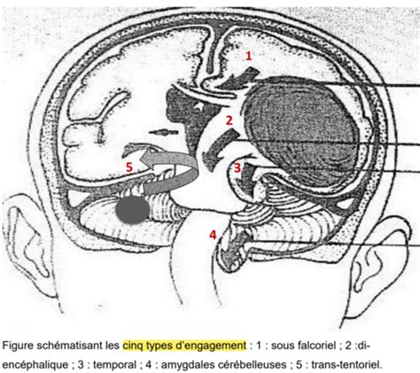 8 Sémio Neuro syndrome méningé et HTIC Flashcards Quizlet