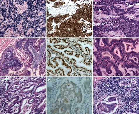 Histopathological And Immunohistochemical Staining Findings A Poorly Download Scientific