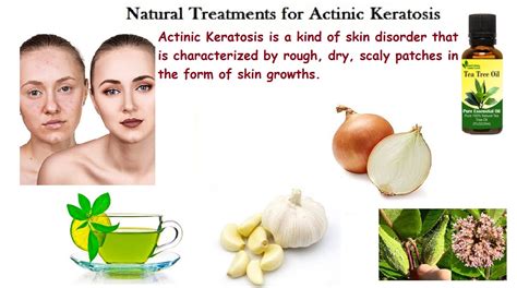 Actinic Keratosis : Natural Treatment for Actinic Keratosis a Skin ...