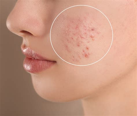 Acne Scars Procedures COSMOCITY Clinic