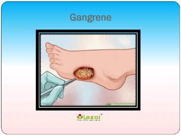 Ppt Gangrene Overview Symptoms Causes Diagnosis And Treatment