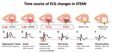 Let S Work Through The Sequence Knowledge Of ECG Facebook