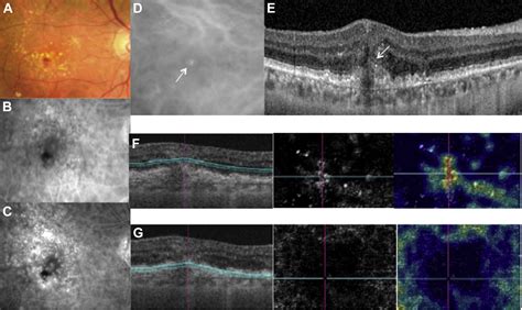 Retinal Angiomatous Proliferation Survey Of Ophthalmology