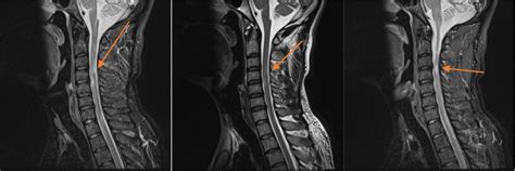 In cervical spine MRI with and without contrast injection, multiple ...