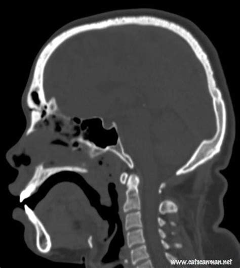 Sagittal Ct Head Diagram Quizlet