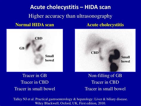 Ultrasound of acute & chronic cholecystitis