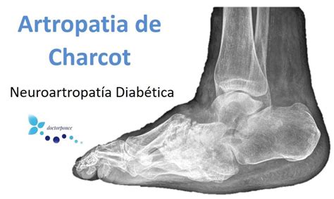 Artropatia De Charcot Cl Nica Reumatol Gica Dr Ponce