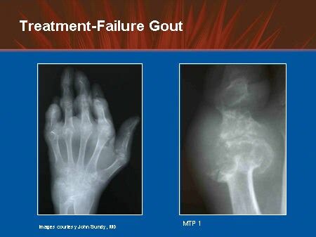 Emerging Strategies For Effective Management Of Treatment Failure Gout